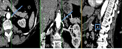 Non-invasive Stenotic Renal Artery Haemodynamics by in silico Medicine